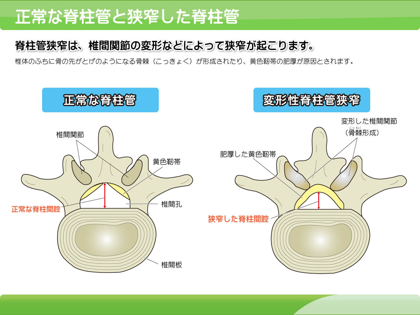 【画像】正常な脊柱管と狭窄した脊柱管の説明スライド