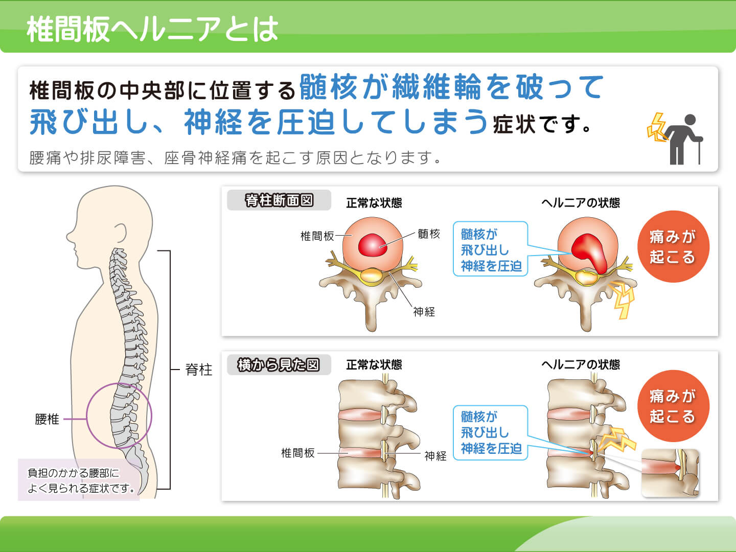 【画像】椎間板ヘルニアとはの説明スライド